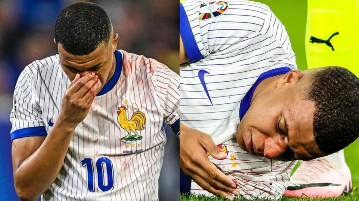 Tragedi Menit Terakhir di Euro 2024: Mbappe Cedera Tulang Hidung